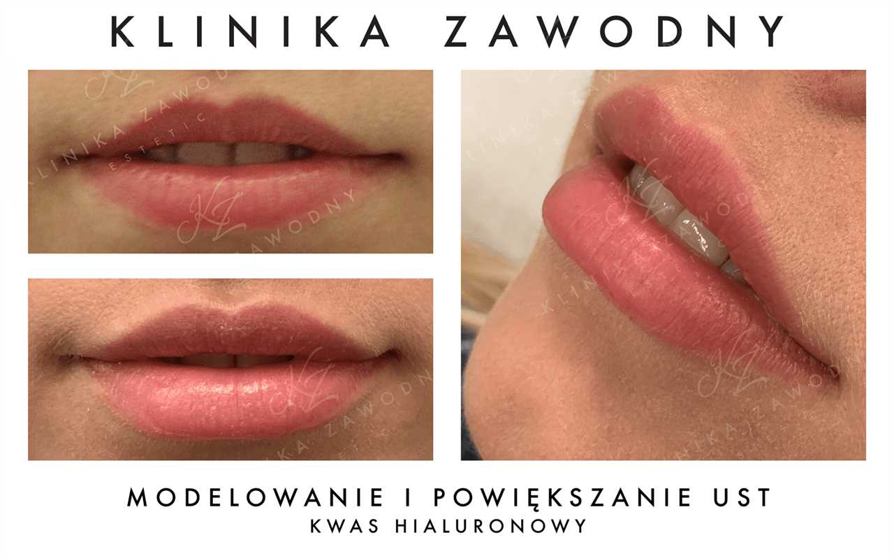 Jakie są średnie ceny powiększania ust w Polsce?