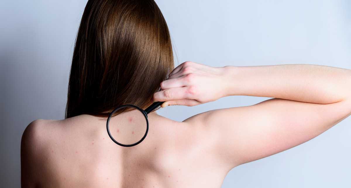 Co na trądzik na plecach - skuteczne sposoby na walkę z trądzikiem