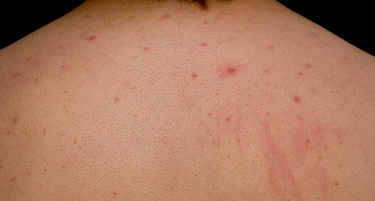 Krosty na plecach u mężczyzn - przyczyny objawy i sposoby leczenia