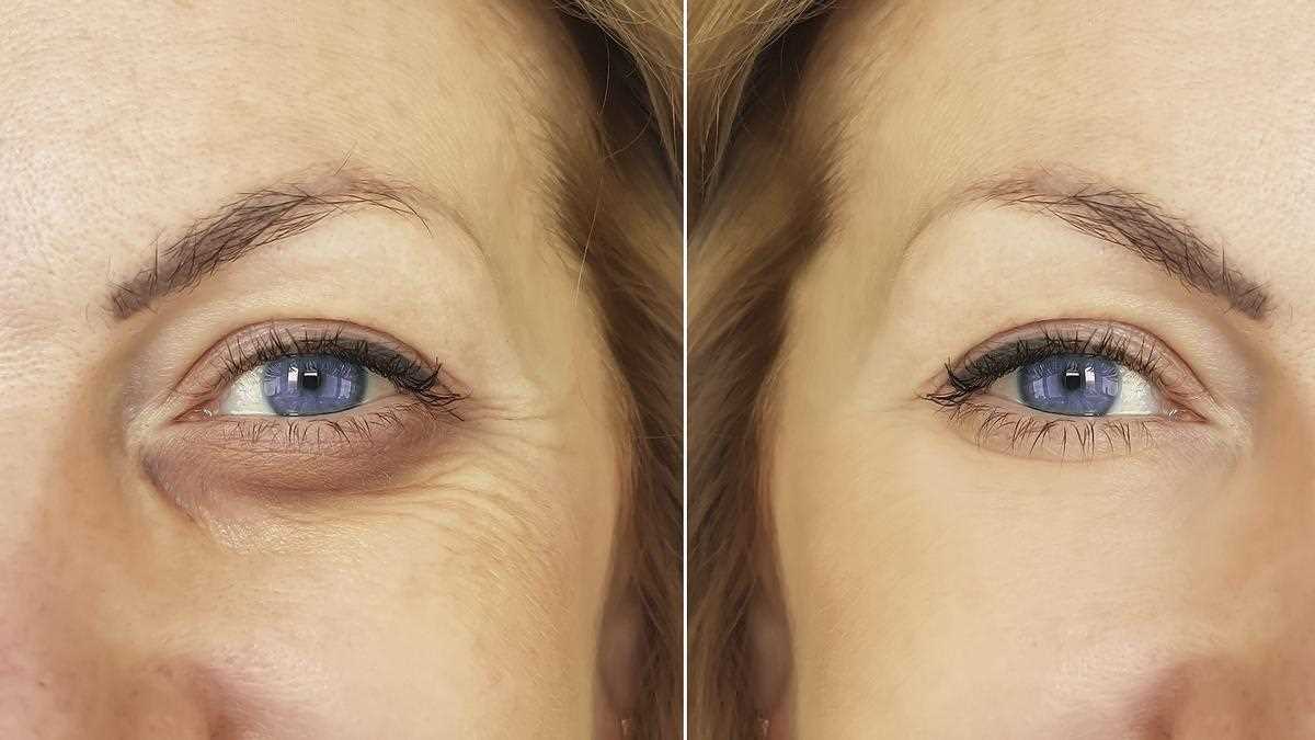 Krem pod oczy na cienie - skuteczne sposoby na pozbycie się cieni pod oczami | Porady dla pięknej skóry oczu 2 Zdrowa dieta