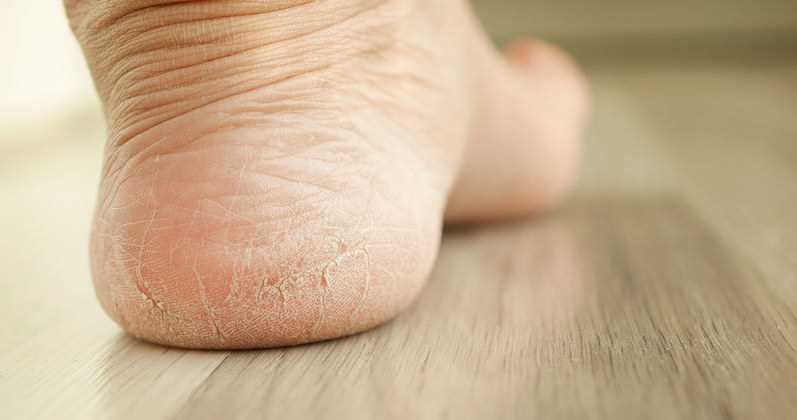 Korzyści płynące z moczenia nóg w sodzie oczyszczonej
