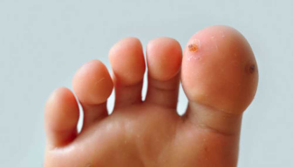 Na odciski na stopach przyczyny objawy i domowe sposoby leczenia