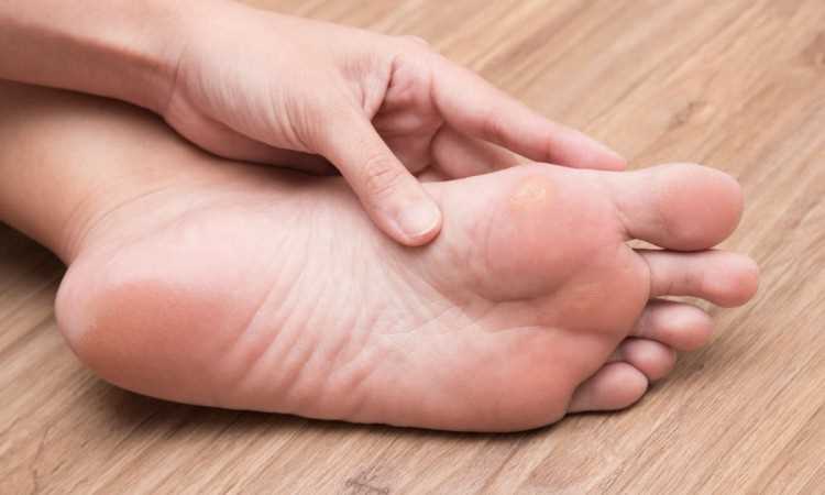 Przyczyny nadmiernej potliwości stóp