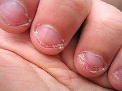 Uszkodzenie skórek wokół paznokci