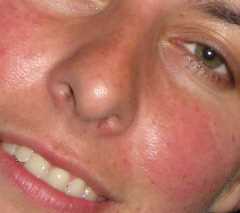 Uczucie gorąca i czerwona twarz przyczyny objawy i sposoby radzenia sobie