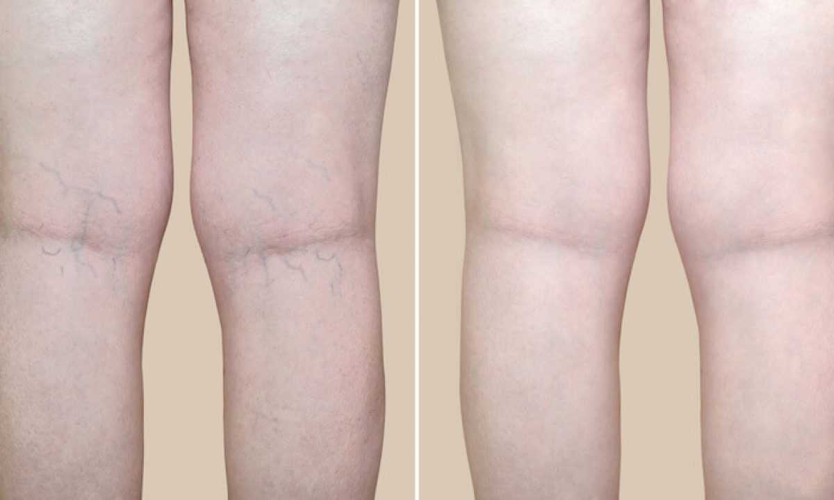 Zamykanie naczynek na nogach - skuteczne metody i zabiegi | Poradnik zdrowia 2 Metody domowe