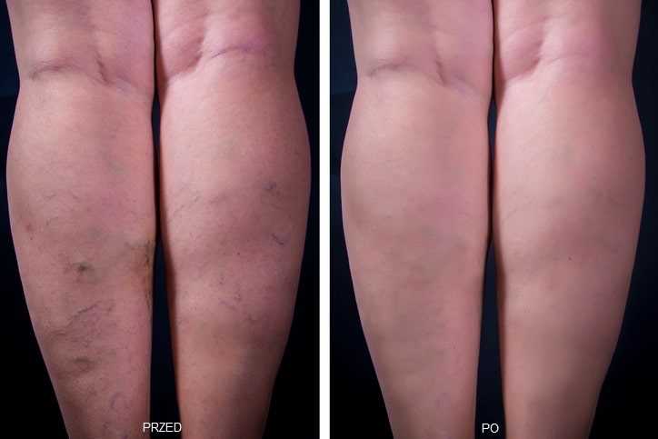 Zamykanie naczynek na nogach - skuteczne metody i zabiegi | Poradnik zdrowia 3 Zimne okłady i kompresy